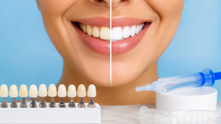 How Long Does Teeth Whitening Last