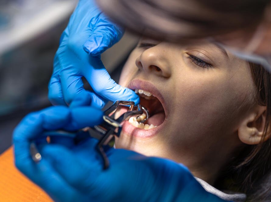 Simple Tooth Extraction vs Surgical Tooth Extraction